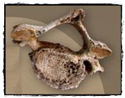 中洲人骨的第五及第六頸椎，椎體外圍有明顯的增生骨質