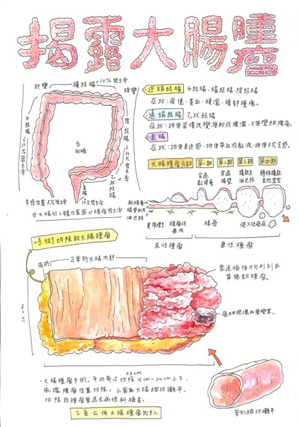 呂佩珊-揭露大腸腫瘤1